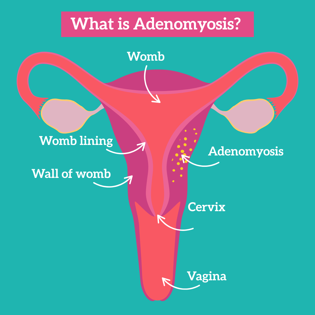 What Is Adenomyosis HotTea Mama What Is Adenomyosis HotTea Mama