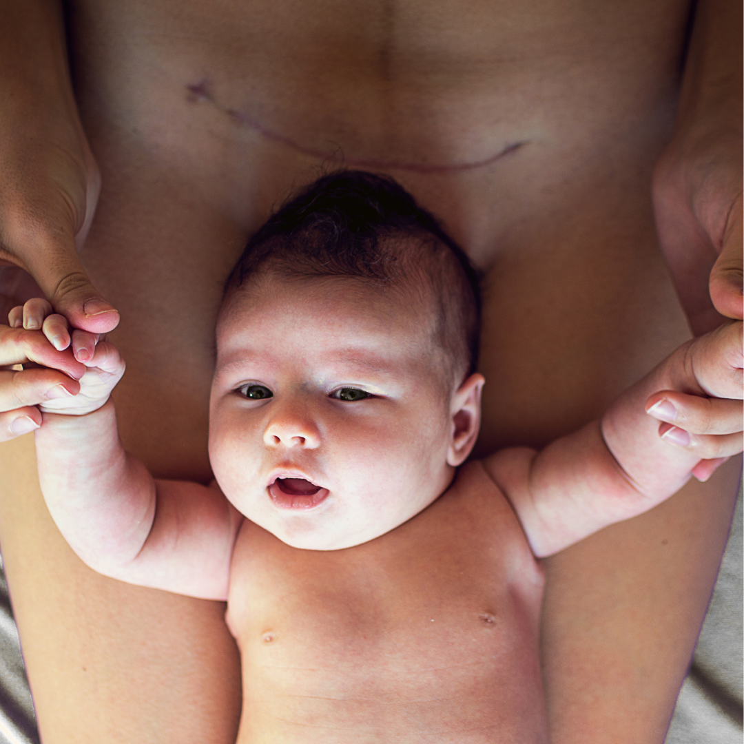 Image of a womans body with a c-section scar and her baby in her arms